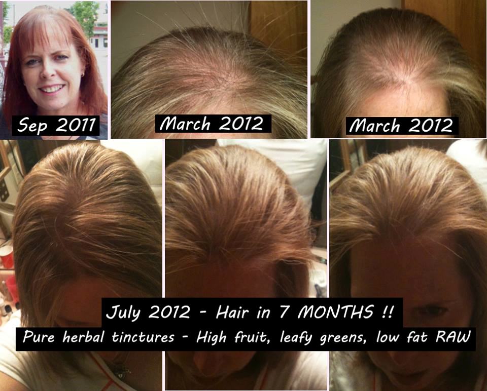 Testimonial - Hair Regrowth #1