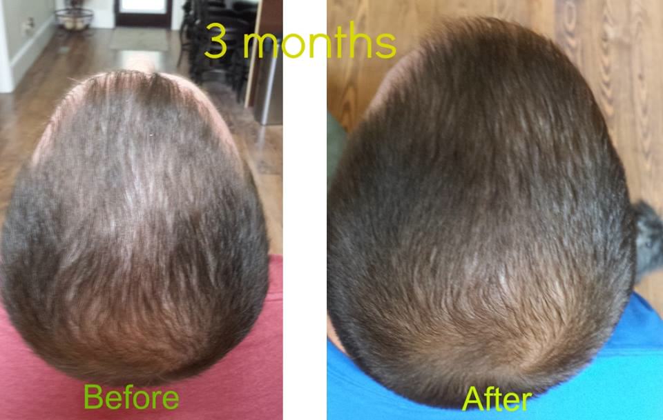 Hair Growth (Receding Hairline)