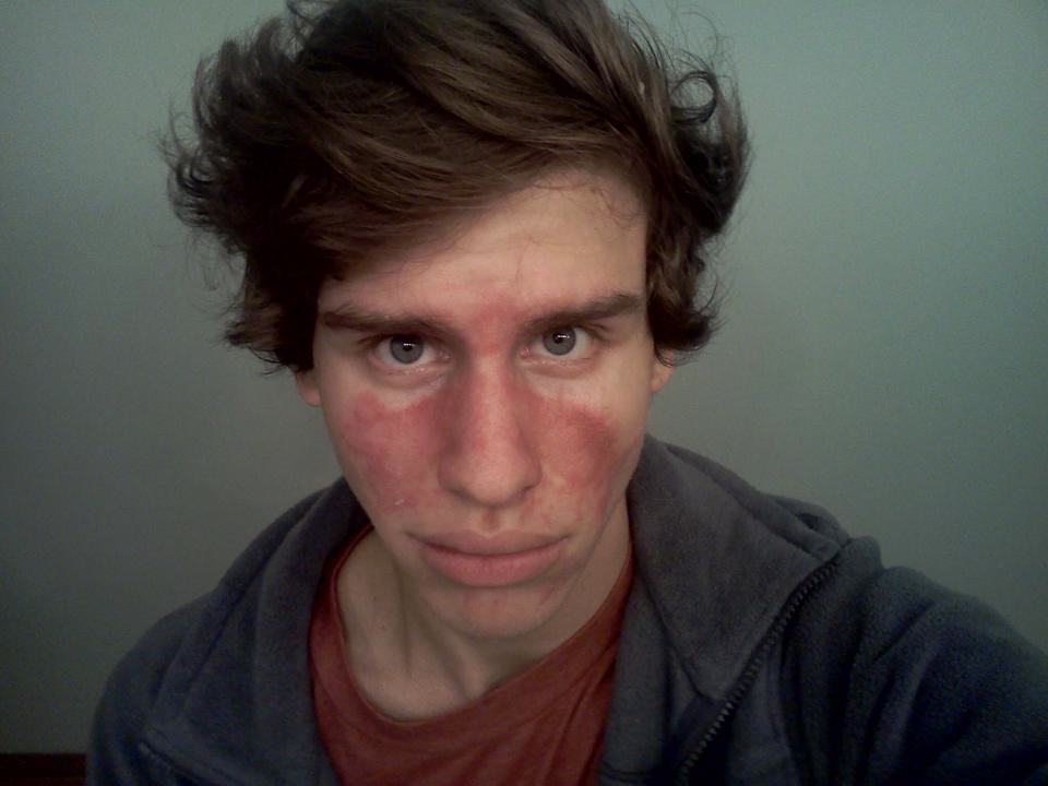 Logan H. - Facial Eczema