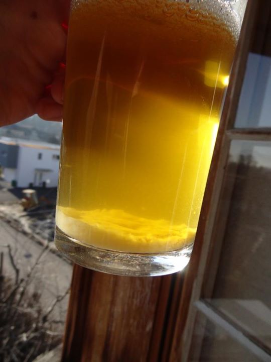 Urine Sediment #15