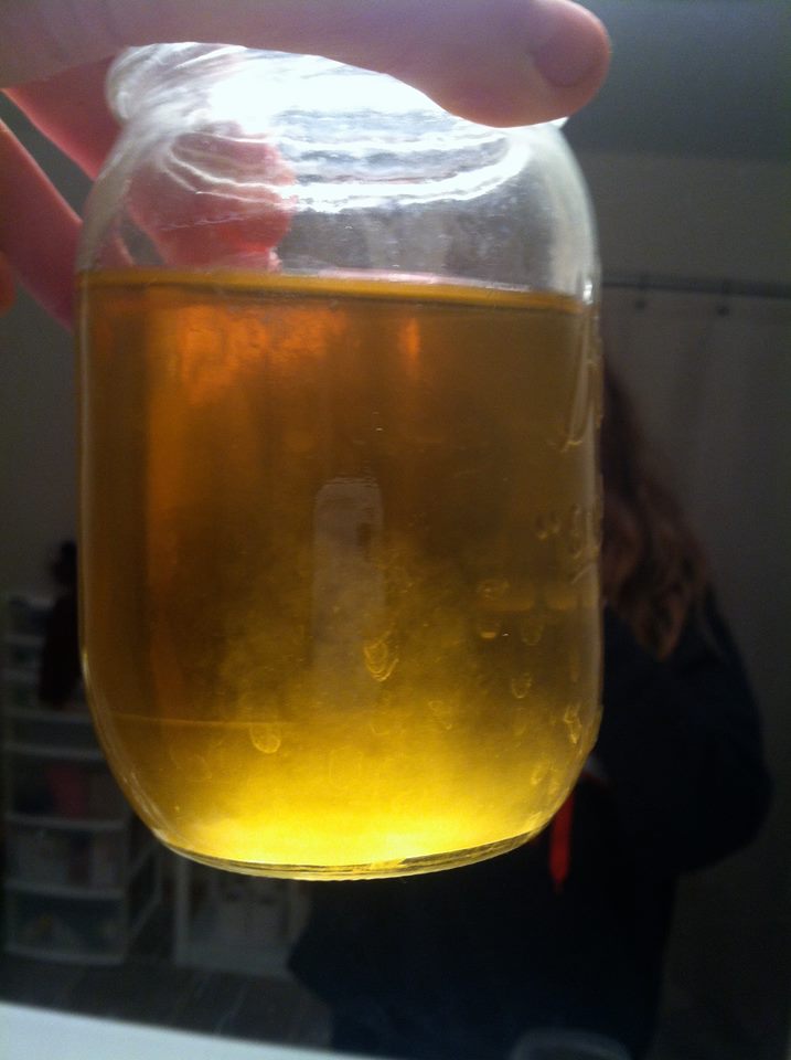 Urine Sediment #35