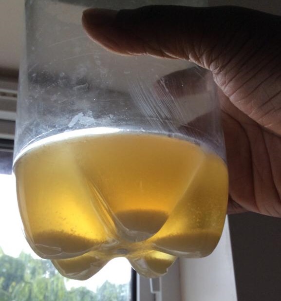 Urine Sediment #43