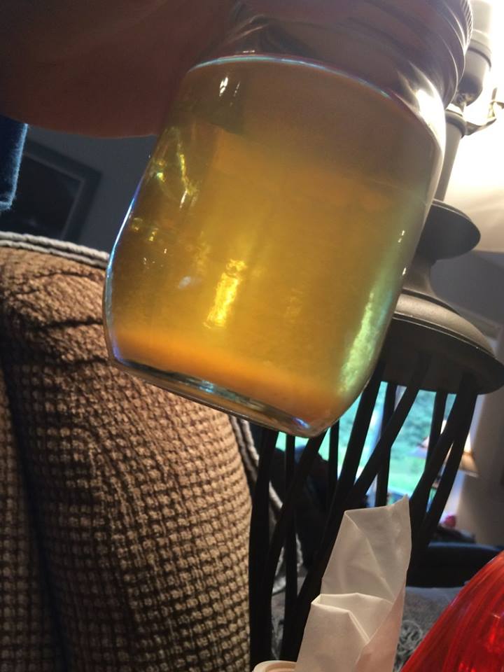 Urine Sediment #46 2
